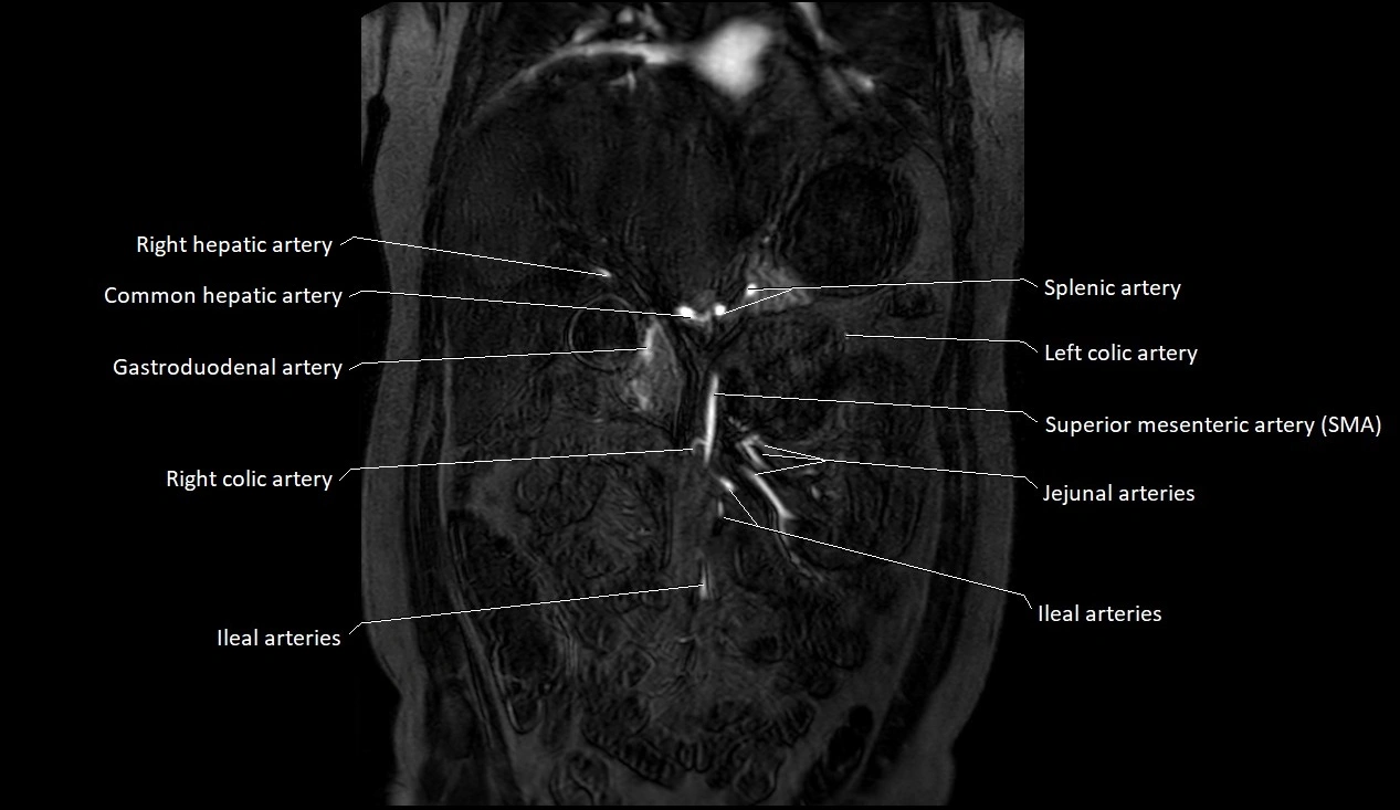 MRA Abdomen coronal anatomy image 5.webp